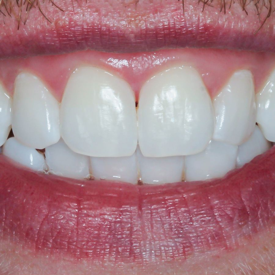 enlighten whitening - after picture